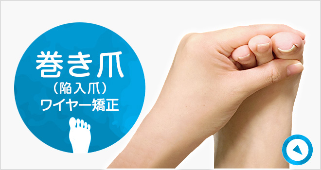 巻き爪(陥入爪)|詳しくはこちら